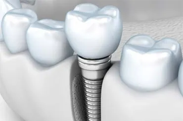 İmplant Tedavisi