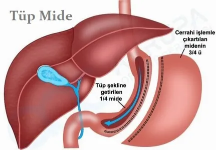 Tüp Mide Ameliyatı