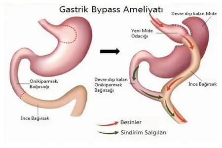 Gastrik Bypass Ameliyatı