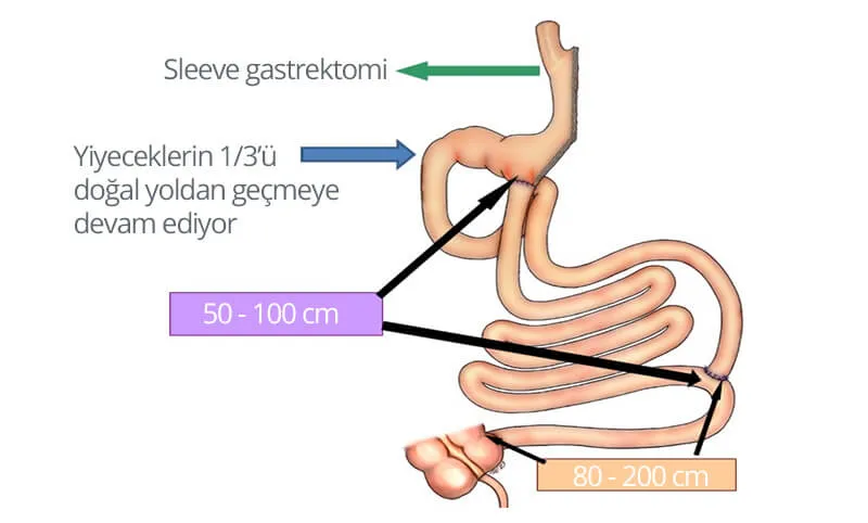 Şeker Hastalığı Ameliyatı