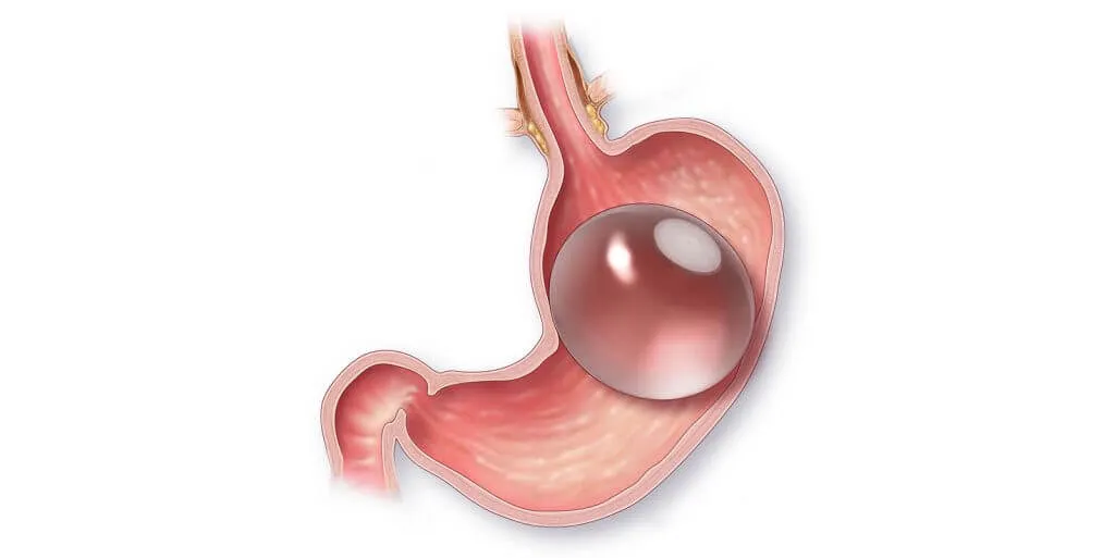 Mide Balonu Uygulamaları