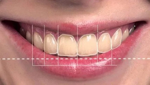 Restoratif Diş Tedavisi