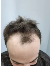 Saç Dökülme Sorunu