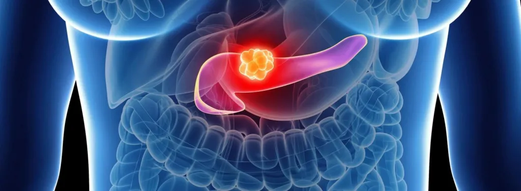 Pankreas Kanseri